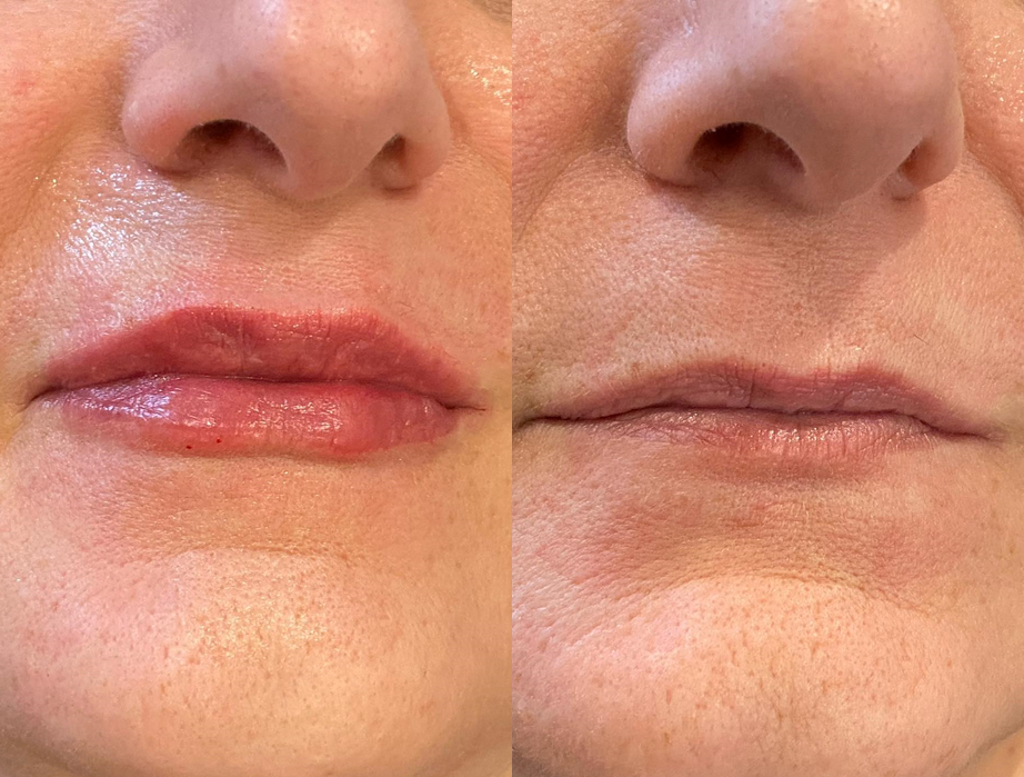  Lip Enhancement <br>Dermafillers
