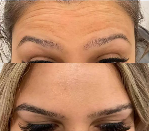 Forehead Anti Wrinkle <br> Treatment