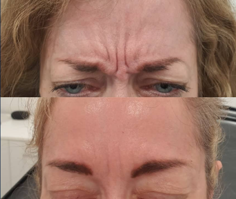 Glabella (frown lines) Anti<br> Wrinkle  Treatment