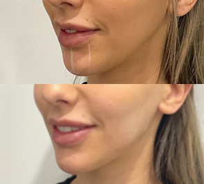 Chin and Jaw enhancement